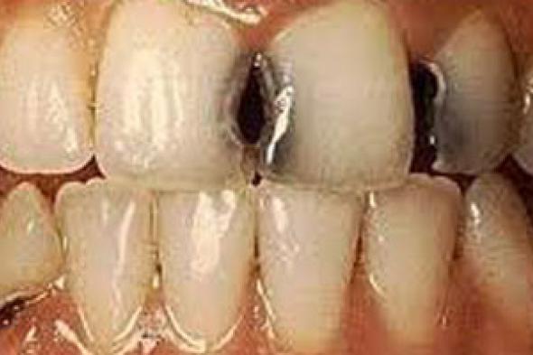أسباب تسوس الأسنان وطرق الوقاية منها