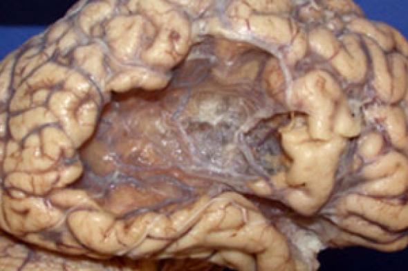 شاهد شكل المخ عقب الإصابة بالسكتة الدماغية.. وأبرز أعراضها
