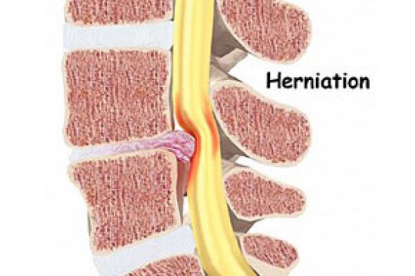 العلاج الدوائى أفضل من الجراحة فى حالات الإصابة بالانزلاق الغضروفى