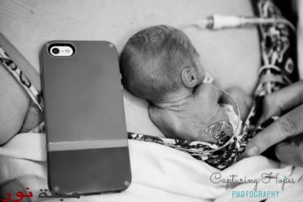 ولادة أصغر طفلة في العالم بحجم الـ iPhone