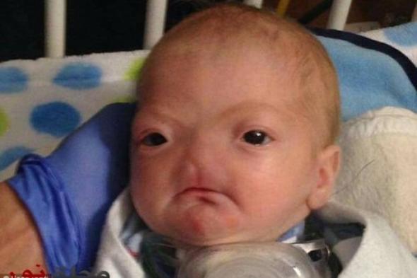 فيسبوك يعتذر لحذفه صورة طفل بدون أنف‎