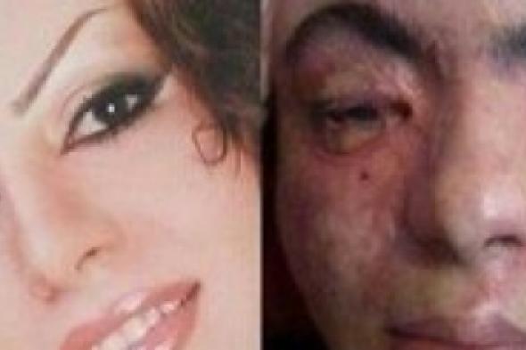 عودة ظاهرة حرق النساء الإيرانيات بالأسيد