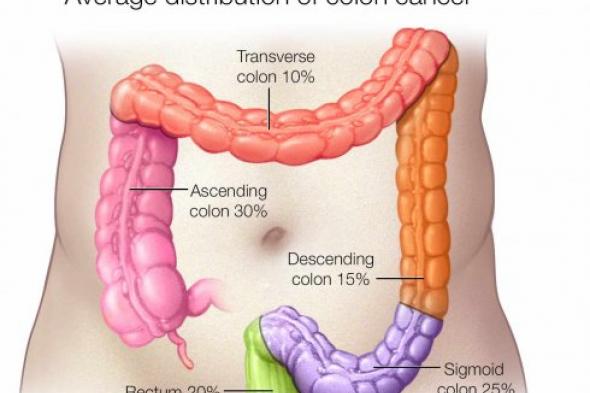 ثلث سرطانات القولون لدى الشباب مرتبطة بالوراثة‎