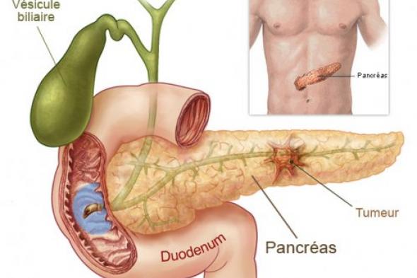 العلم يقترب من تشخيص سرطان البنكرياس عن طريق البول