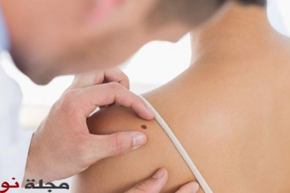 عدد الشامات مؤشر لخطر سرطان الجلد