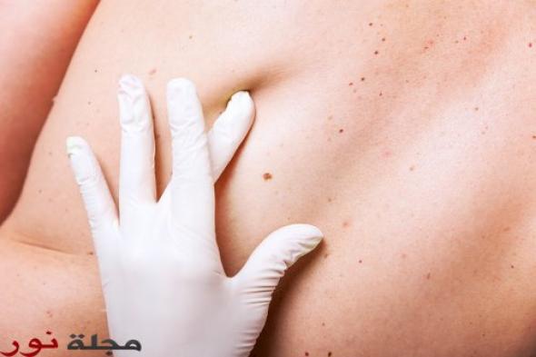 علاج جديد قد يقضي على سرطان الجلد