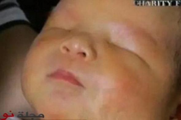 بالصورة : ولادة طفل دون عينين في الصين