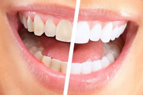 6 طرق لتبييض وإزالة الجير عن الأسنان بشكل طبيعي