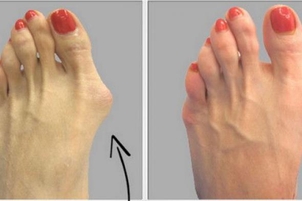 إليكم كيفية علاج إعوجاج القدم طبيعياً.. وبدون جراحة